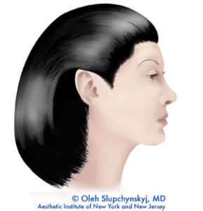 SLUPlift Minimally Invasive Facelift Chatham, New Jersey - The next level of mini-facelifts. A Patented technique | Chatham Medispa, Dr. Oleh Slupchynskyj