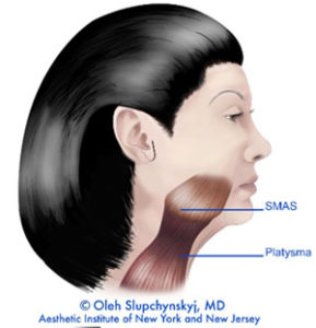 SLUPlift Minimally Invasive Facelift Chatham, New Jersey - The next level of mini-facelifts. A Patented technique | Chatham Medispa, Dr. Oleh Slupchynskyj