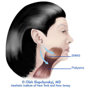 SLUPlift Minimally Invasive Facelift Chatham, New Jersey - The next level of mini-facelifts. A Patented technique | Chatham Medispa, Dr. Oleh Slupchynskyj