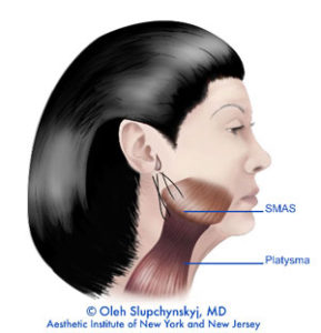 SLUPlift Minimally Invasive Facelift Chatham, New Jersey - The next level of mini-facelifts. A Patented technique | Chatham Medispa, Dr. Oleh Slupchynskyj