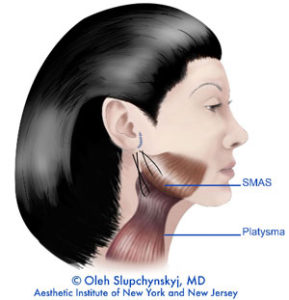 SLUPlift Minimally Invasive Facelift Chatham, New Jersey - The next level of mini-facelifts. A Patented technique | Chatham Medispa, Dr. Oleh Slupchynskyj
